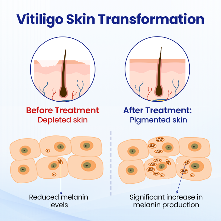 Cvreoz® Vitiligo Treatment Spray — Visible Results in Weeks, 100% Natural & Steroid-Free (Offer)