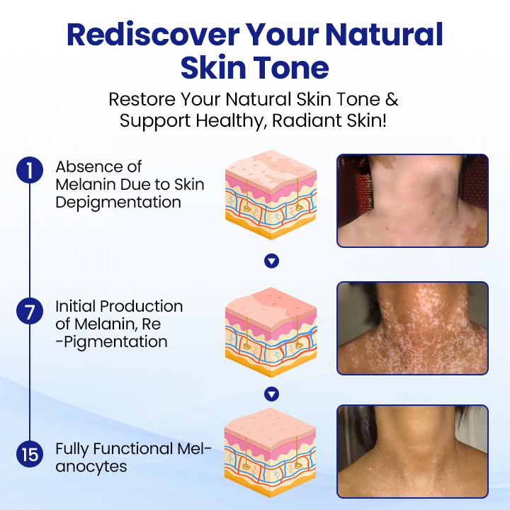 Cvreoz® Vitiligo Treatment Spray — Visible Results in Weeks, 100% Natural & Steroid-Free (Offer)