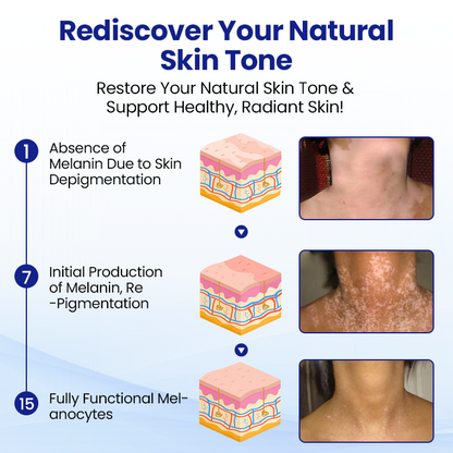 Cvreoz® Vitiligo Treatment Spray — Visible Results in Weeks, 100% Natural & Steroid-Free (Offer)