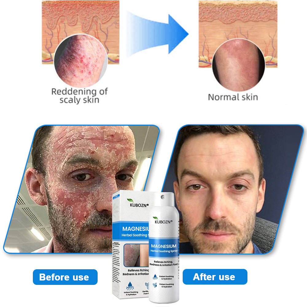 ✅  Official Store: KUBOZN® Magnesium Herbal Psoriasis Spray ⚕️ FDA Certified (Offer)