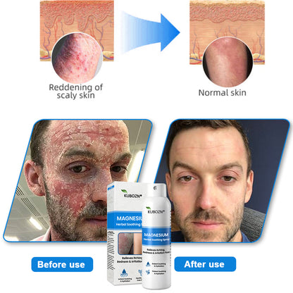 ✅  Official Store: KUBOZN® Magnesium Herbal Psoriasis Spray ⚕️ FDA Certified (Offer)