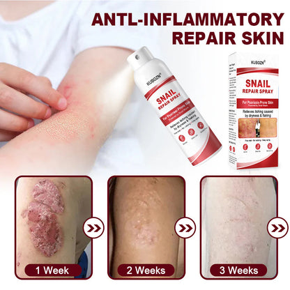 KUBOZN® Snail Repair Spray for Itchy, Flaky Psoriasis Skin 1