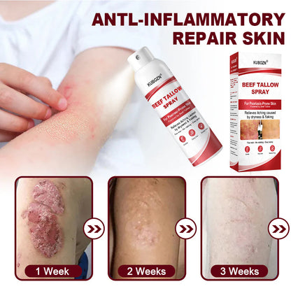 KUBOZN® Beef Tallow Spray for Itchy, Flaky Psoriasis Skin