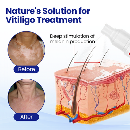 Cvreoz® Vitiligo Treatment Spray — Visible Results in Weeks, 100% Natural & Steroid-Free (Offer)